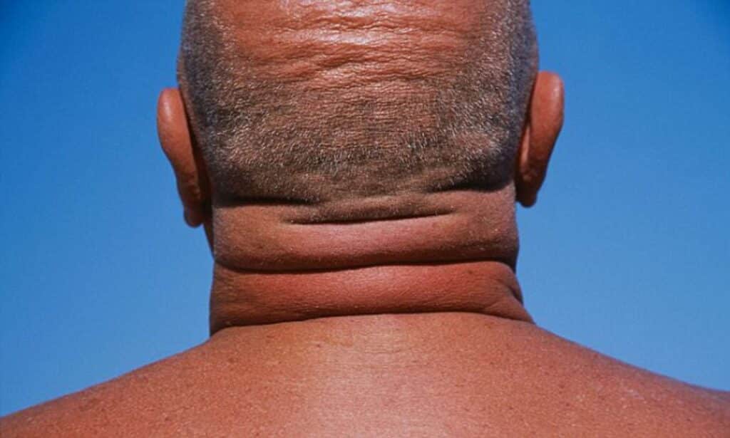 A man with a big neck that might indicate health problems