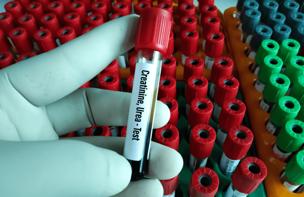 A sample of blood with a low Bun/creatinine ratio