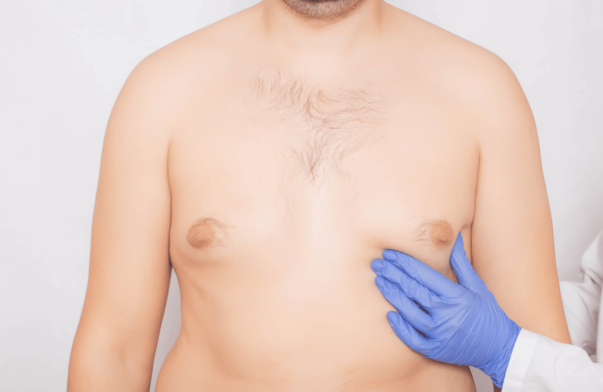 A man with gynecomastia aka man boobs