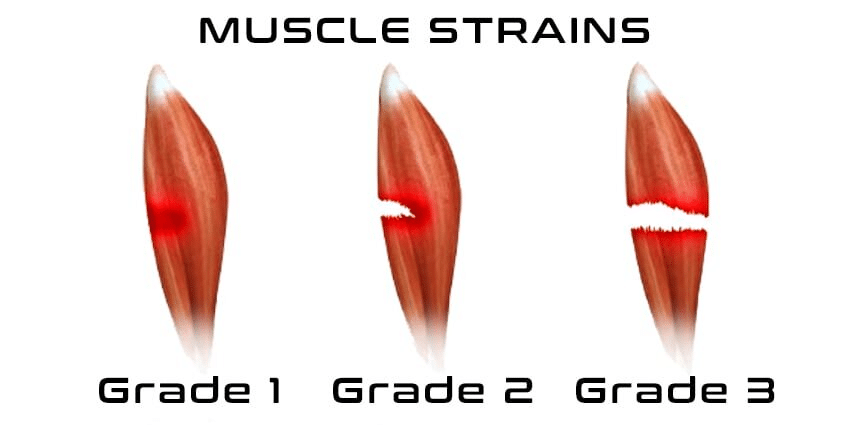 Muscle Strains