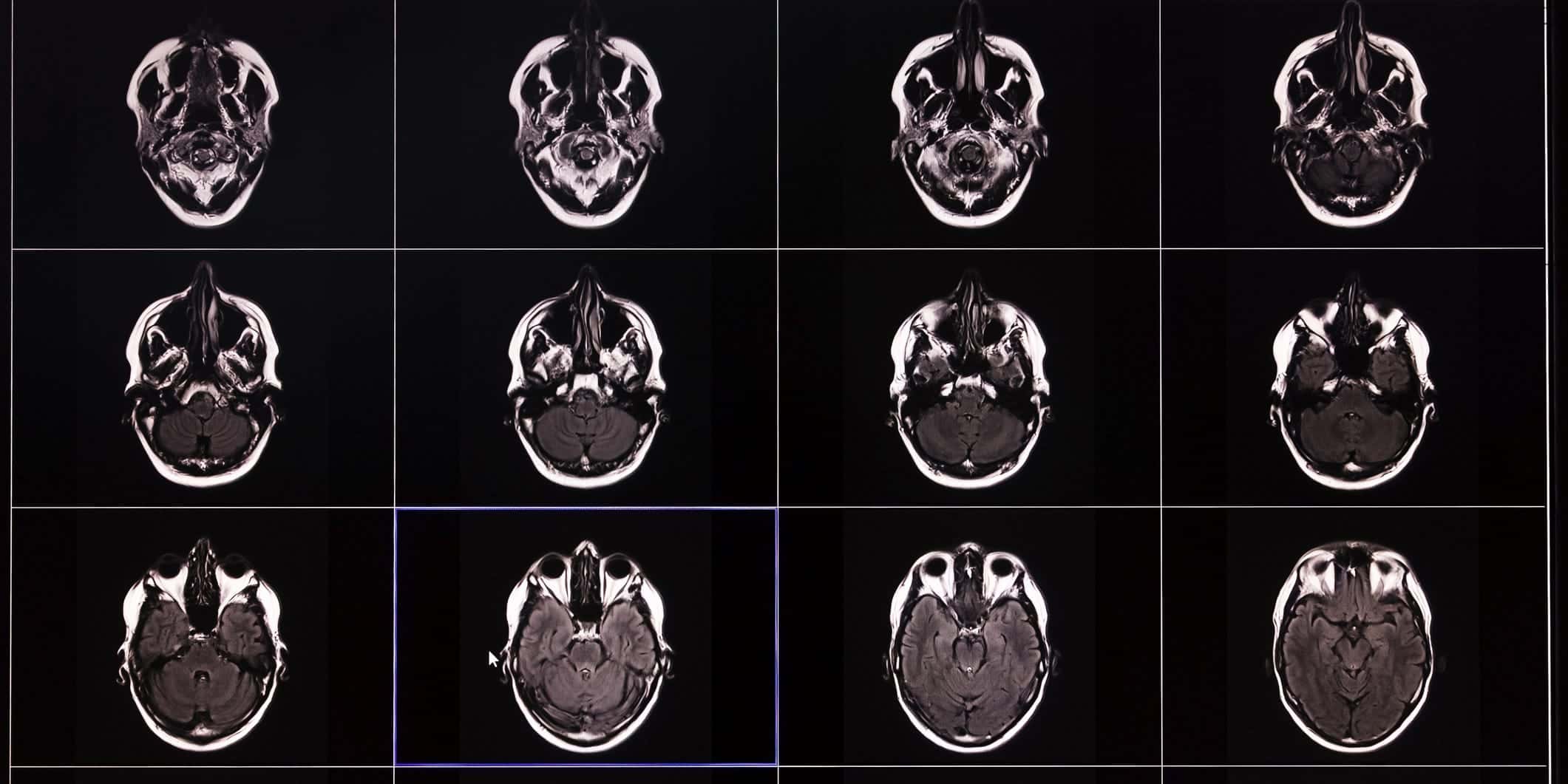 harvard-study-reveals-surprising-memory-loss-regions