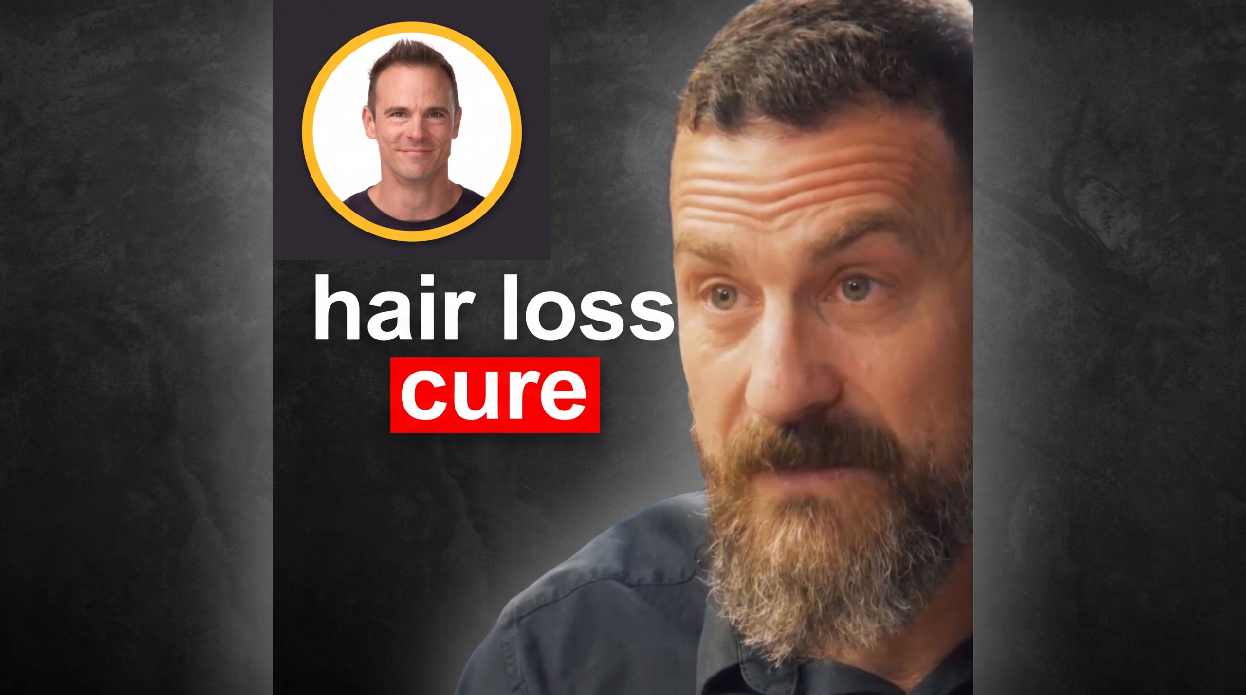 low-dose-finasteride-blocks-hair-loss