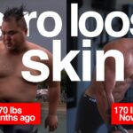 without-loose-skin-after-hundred-pound-weight-loss